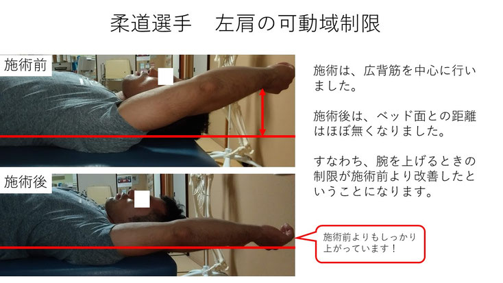 野球 野球肩 肩が痛い ピッチャー リトルリーガーズショルダー 腱板損傷 投球傷害 水泳 競泳 腰痛 分離症 分離すべり症 水泳肩スイマーズショルダー 水泳肩 スイマーズショルダー治療 スイマーズショルダー治るのか 岐阜 岐阜市 岐阜市茜部 岐阜市東鶉 岐阜市南鶉 岐阜市中鶉 岐阜市柳津町 羽島市 羽島郡 笠松町 岐南町 茜部 鶉 東鶉 中鶉 南鶉 柳津 笠松