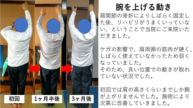 五十肩の施術例。初回から3か月後にかけて肩の可動域が改善し、腕を上げられるようになった症例。