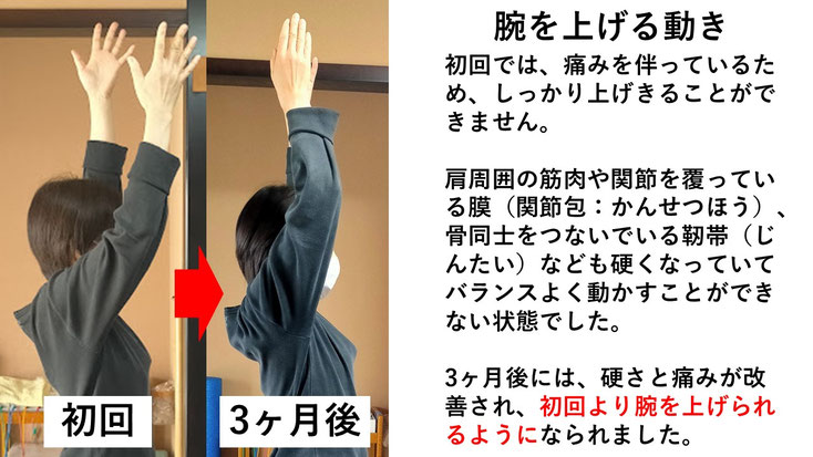 五十肩の施術例。初回から3か月後にかけて肩の可動域が改善し、腕を痛み無く上げられるようになった症例