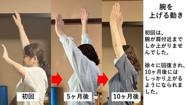 五十肩の施術例。初回から10か月後にかけて肩の可動域が改善し、腕を真上まで上げられるようになり、夜間痛も無くなった症例