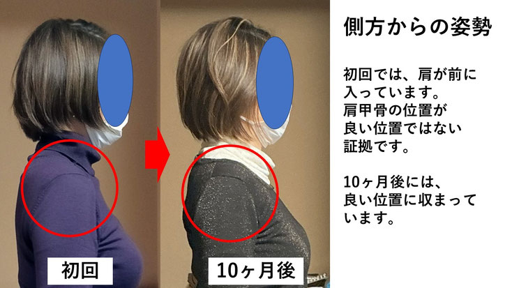 五十肩の施術例。初回から10か月後にかけて肩の可動域が改善した症例。