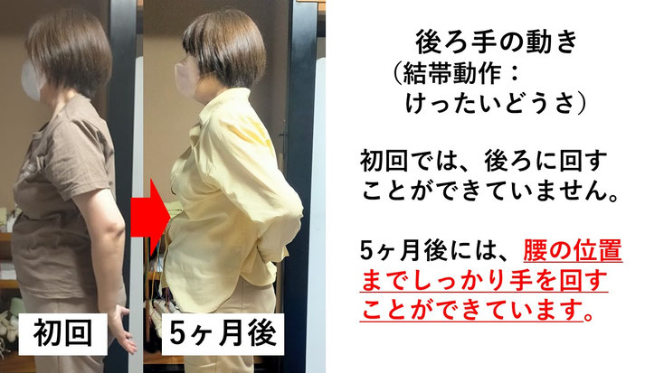 五十肩の施術例。初回から5か月後にかけて肩の可動域が改善し、手を後ろに回せるようになった症例