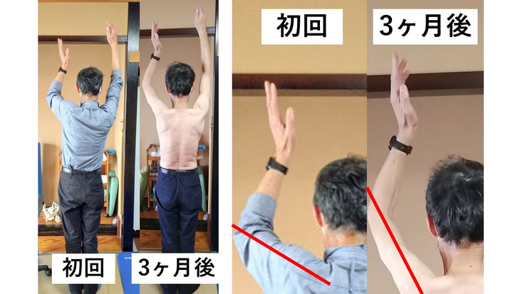 五十肩の60代男性。発症から1年後に来院し、施術3か月で肩関節の可動域は改善したものの、インナーマッスルの筋萎縮により左腕を十分に上げられない状態。
