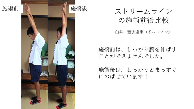 肩関節の痛み　姿勢　肩甲骨　肩甲骨痛み　背中の痛み　野球肩の原因　野球肩原因　野球肩治し方　野球肩体操　野球肩ストレッチ　野球　野球肩　肩が痛い　ピッチャー　リトルリーガーズショルダー　腱板損傷　投球傷害　水泳　競泳　腰痛　分離症　分離すべり症　水泳肩スイマーズショルダー　水泳肩　スイマーズショルダー治療　スイマーズショルダー治るのか　岐阜　岐阜市　岐阜市茜部　岐阜市東鶉　岐阜市南鶉　岐阜市中鶉　岐阜市柳津町　羽島市　羽島郡　笠松町　岐南町　茜部　鶉　東鶉　中鶉　南鶉　柳津　笠松　