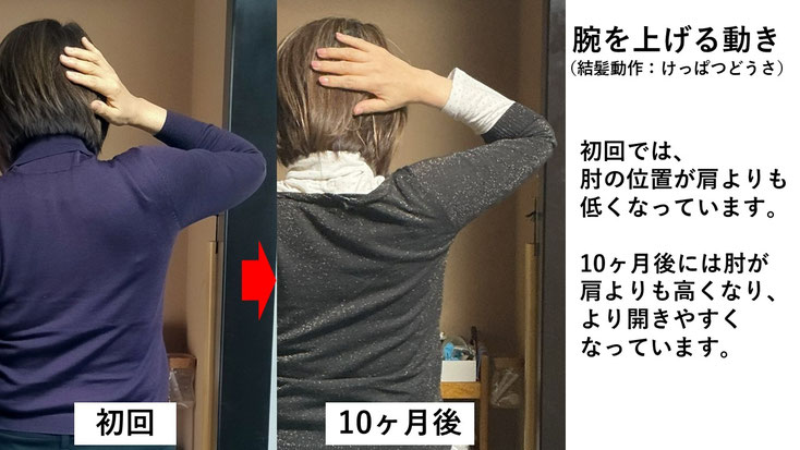 五十肩の施術例。初回から10か月後にかけて肩の可動域が改善し、腕を頭の後ろに挙げられるようになった症例。