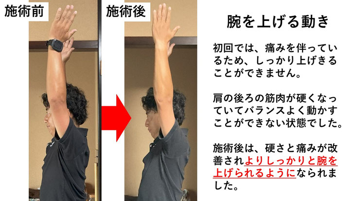 五十肩の施術例。初回の施術前後で肩の痛みと動きのスムーズさが改善した症例。