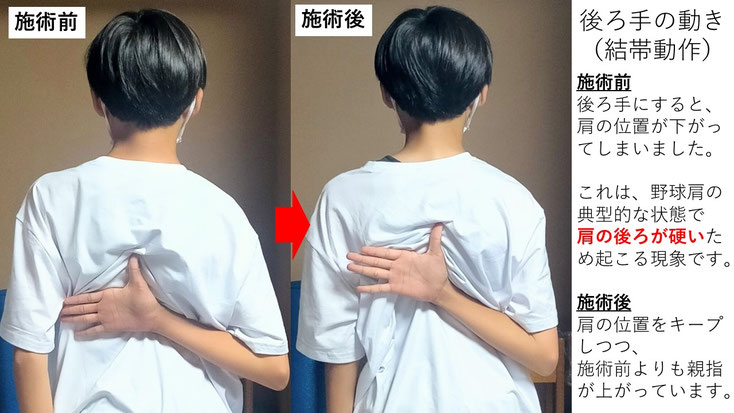 右投げ中学生ピッチャーの野球肩施術前後の後ろ手の動きの比較
