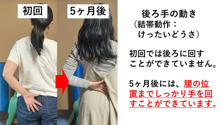 五十肩の施術例。初回から5か月後にかけて肩の可動域が改善し、腕を後ろに回せるようになった症例