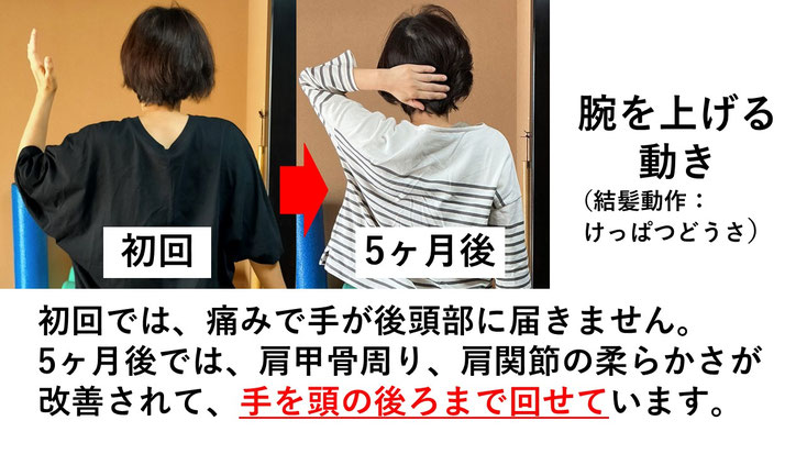 五十肩の施術例。初回から5か月後にかけて肩の可動域が改善し、腕を痛み無く頭の後ろに回せるようになった症例