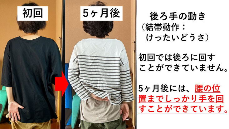 五十肩の施術例。初回から5か月後にかけて肩の可動域が改善し、腕を痛み無く後ろに回せるようになった症例