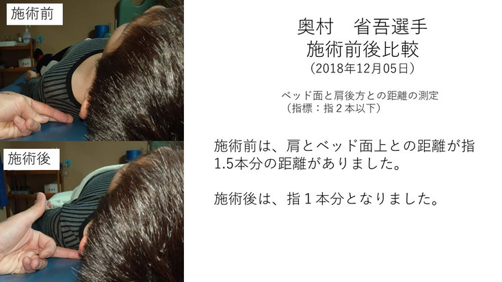 肩関節の痛み　姿勢　肩甲骨　肩甲骨痛み　背中の痛み　野球肩の原因　野球肩原因　野球肩治し方　野球肩体操　野球肩ストレッチ　野球　野球肩　肩が痛い　ピッチャー　リトルリーガーズショルダー　腱板損傷　投球傷害　水泳　競泳　腰痛　分離症　分離すべり症　水泳肩スイマーズショルダー　水泳肩　スイマーズショルダー治療　スイマーズショルダー治るのか　岐阜　岐阜市　岐阜市茜部　岐阜市東鶉　岐阜市南鶉　岐阜市中鶉　岐阜市柳津町　羽島市　羽島郡　笠松町　岐南町　茜部　鶉　東鶉　中鶉　南鶉　柳津　笠松　