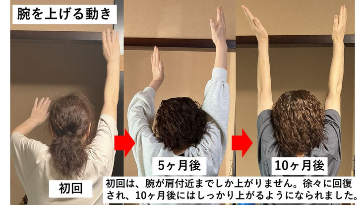 五十肩の施術例。初回から10か月後にかけて肩の可動域が改善し、腕を真上まで上げられるようになり、夜間痛も無くなった症例