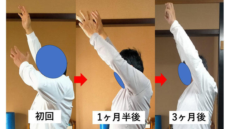 五十肩の施術例。初回から3か月後にかけて肩の可動域が改善し、腕を上げられるようになった症例。