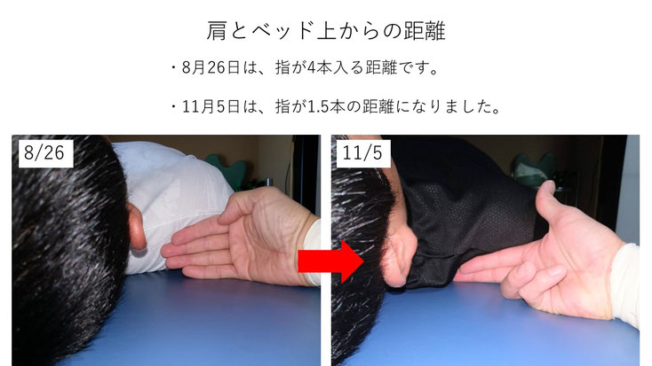 肩関節の痛み 姿勢 姿勢改善 肩甲骨 肩甲骨はがし 肩甲骨痛み 背中の痛み 野球肩の原因 野球肩原因 野球肩治し方 野球肩体操 野球肩ストレッチ 野球 野球肩 肩が痛い ピッチャー リトルリーガーズショルダー 腱板損傷 投球傷害 水泳 競泳 腰痛 分離症 分離すべり症 水泳肩スイマーズショルダー 水泳肩 スイマーズショルダー治療 スイマーズショルダー治るのか 岐阜 岐阜市 岐阜市茜部 岐阜市東鶉 岐阜市南鶉 岐阜市中鶉 岐阜市柳津町 羽島市 羽島郡 笠松町 岐南町 茜部 鶉 東鶉 中鶉 南鶉 柳津 笠松