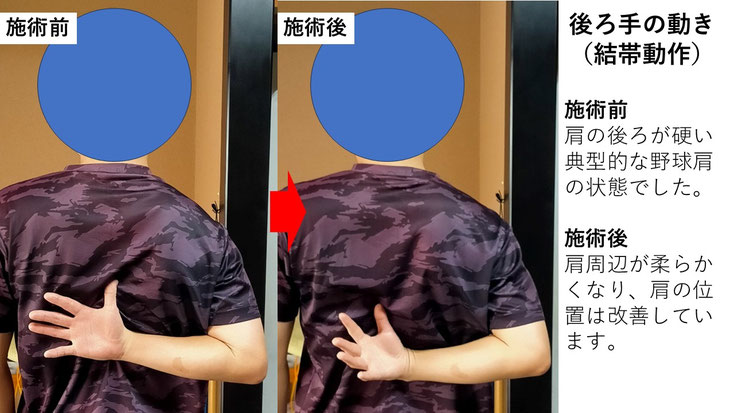 右投げ社会人内野手の野球肩施術前後の後ろ手の動きの比較