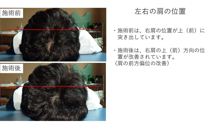 肩関節の痛み　姿勢　姿勢改善　肩甲骨　肩甲骨はがし　肩甲骨痛み　背中の痛み　野球肩の原因　野球肩原因　野球肩治し方　野球肩体操　野球肩ストレッチ　野球　野球肩　肩が痛い　ピッチャー　リトルリーガーズショルダー　腱板損傷　投球傷害　水泳　競泳　腰痛　分離症　分離すべり症　水泳肩スイマーズショルダー　水泳肩　スイマーズショルダー治療　スイマーズショルダー治るのか　岐阜　岐阜市　岐阜市茜部　岐阜市東鶉　岐阜市南鶉　岐阜市中鶉　岐阜市柳津町　羽島市　羽島郡　笠松町　岐南町　茜部　鶉　東鶉　中鶉　南鶉　柳津　笠松　
