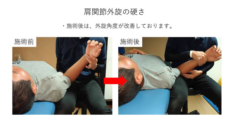 肩関節の痛み 姿勢 姿勢改善 肩甲骨 肩甲骨はがし 肩甲骨痛み 背中の痛み 野球肩の原因 野球肩原因 野球肩治し方 野球肩体操 野球肩ストレッチ 野球 野球肩 肩が痛い ピッチャー リトルリーガーズショルダー 腱板損傷 投球傷害 水泳 競泳 腰痛 分離症 分離すべり症 水泳肩スイマーズショルダー 水泳肩 スイマーズショルダー治療 スイマーズショルダー治るのか 岐阜 岐阜市 岐阜市茜部 岐阜市東鶉 岐阜市南鶉 岐阜市中鶉 岐阜市柳津町 羽島市 羽島郡 笠松町 岐南町 茜部 鶉 東鶉 中鶉 南鶉 柳津 笠松