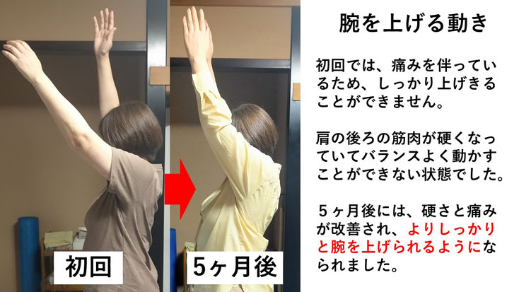 五十肩の施術例。初回から5か月後にかけて肩の可動域が改善し、腕を真上まで上げられるようになった症例