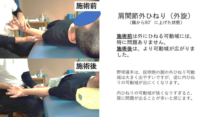 右投げ高校生内野手の野球肩施術前後の肩の外ひねりの動きの比較