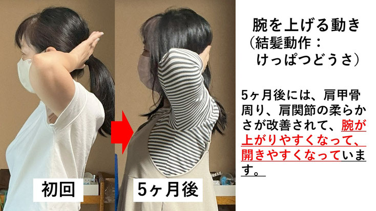五十肩の施術例。初回から5か月後にかけて肩の可動域が改善し、腕を頭の後ろに上げられるようになった症例