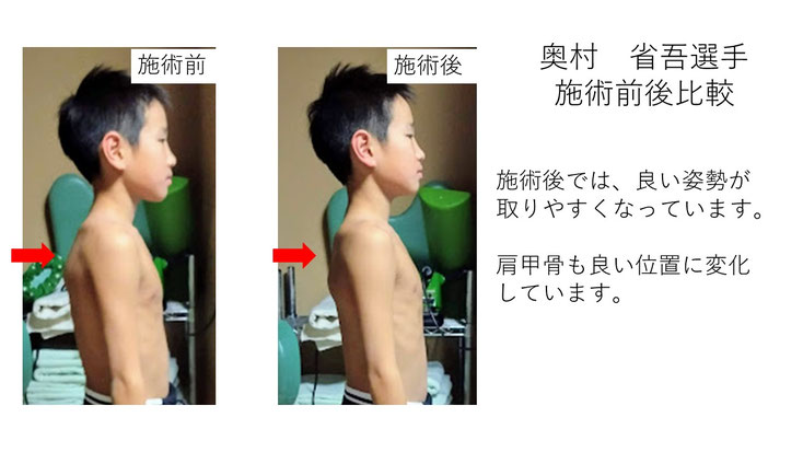 肩関節の痛み　姿勢　肩甲骨　肩甲骨痛み　背中の痛み　野球肩の原因　野球肩原因　野球肩治し方　野球肩体操　野球肩ストレッチ　野球　野球肩　肩が痛い　ピッチャー　リトルリーガーズショルダー　腱板損傷　投球傷害　水泳　競泳　腰痛　分離症　分離すべり症　水泳肩スイマーズショルダー　水泳肩　スイマーズショルダー治療　スイマーズショルダー治るのか　岐阜　岐阜市　岐阜市茜部　岐阜市東鶉　岐阜市南鶉　岐阜市中鶉　岐阜市柳津町　羽島市　羽島郡　笠松町　岐南町　茜部　鶉　東鶉　中鶉　南鶉　柳津　笠松　