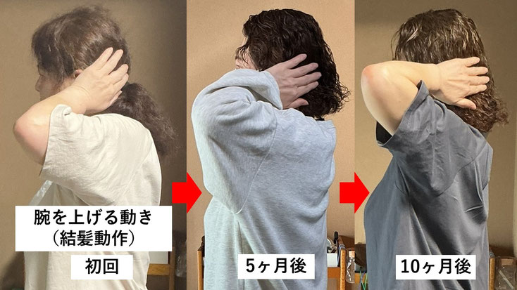 五十肩の施術例。初回から10か月後にかけて肩の可動域が改善し、手を頭の後ろまで上げられるようになり、夜間痛も無くなった症例
