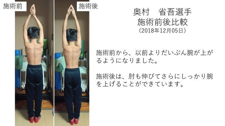 肩関節の痛み　姿勢　肩甲骨　肩甲骨痛み　背中の痛み　野球肩の原因　野球肩原因　野球肩治し方　野球肩体操　野球肩ストレッチ　野球　野球肩　肩が痛い　ピッチャー　リトルリーガーズショルダー　腱板損傷　投球傷害　水泳　競泳　腰痛　分離症　分離すべり症　水泳肩スイマーズショルダー　水泳肩　スイマーズショルダー治療　スイマーズショルダー治るのか　岐阜　岐阜市　岐阜市茜部　岐阜市東鶉　岐阜市南鶉　岐阜市中鶉　岐阜市柳津町　羽島市　羽島郡　笠松町　岐南町　茜部　鶉　東鶉　中鶉　南鶉　柳津　笠松　