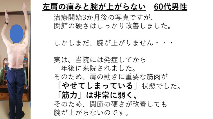 五十肩の60代男性。発症から1年後に来院し、施術3か月で肩関節の可動域は改善したものの、インナーマッスルの筋萎縮により左腕を十分に上げられない状態。