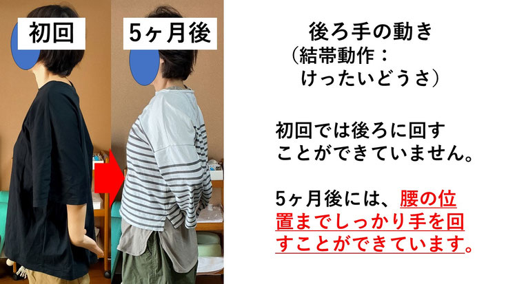 五十肩の施術例。初回から5か月後にかけて肩の可動域が改善し、腕を痛み無く後ろに回せるようになった症例