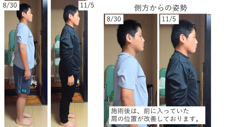 肩関節の痛み 姿勢 姿勢改善 肩甲骨 肩甲骨はがし 肩甲骨痛み 背中の痛み 野球肩の原因 野球肩原因 野球肩治し方 野球肩体操 野球肩ストレッチ 野球 野球肩 肩が痛い ピッチャー リトルリーガーズショルダー 腱板損傷 投球傷害 水泳 競泳 腰痛 分離症 分離すべり症 水泳肩スイマーズショルダー 水泳肩 スイマーズショルダー治療 スイマーズショルダー治るのか 岐阜 岐阜市 岐阜市茜部 岐阜市東鶉 岐阜市南鶉 岐阜市中鶉 岐阜市柳津町 羽島市 羽島郡 笠松町 岐南町 茜部 鶉 東鶉 中鶉 南鶉 柳津 笠松