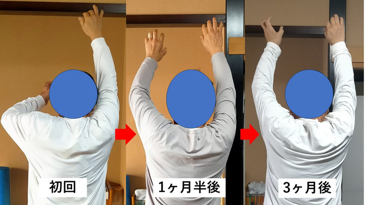 五十肩の施術例。初回から3か月後にかけて肩の可動域が改善し、腕を上げられるようになった症例。