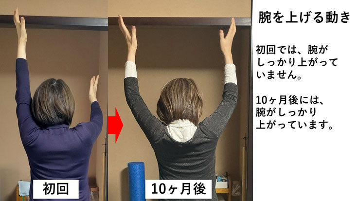 五十肩の施術例。初回から10か月後にかけて肩の可動域が改善し、腕を上げることができるようになった症例。