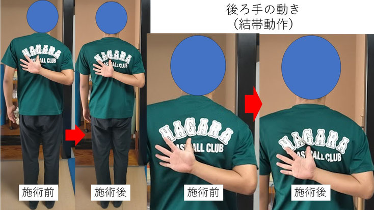 右投げ高校生内野手の野球肩施術前後の後ろ手の動きの比較