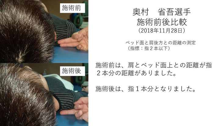 肩関節の痛み　姿勢　肩甲骨　肩甲骨痛み　背中の痛み　野球肩の原因　野球肩原因　野球肩治し方　野球肩体操　野球肩ストレッチ　野球　野球肩　肩が痛い　ピッチャー　リトルリーガーズショルダー　腱板損傷　投球傷害　水泳　競泳　腰痛　分離症　分離すべり症　水泳肩スイマーズショルダー　水泳肩　スイマーズショルダー治療　スイマーズショルダー治るのか　岐阜　岐阜市　岐阜市茜部　岐阜市東鶉　岐阜市南鶉　岐阜市中鶉　岐阜市柳津町　羽島市　羽島郡　笠松町　岐南町　茜部　鶉　東鶉　中鶉　南鶉　柳津　笠松　