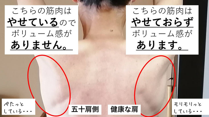 五十肩の60代男性。発症から1年後に来院し、施術3か月で肩関節の可動域は改善したものの、インナーマッスルの筋萎縮により左腕を十分に上げられない状態。