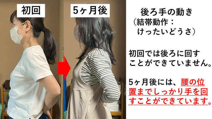 五十肩の施術例。初回から5か月後にかけて肩の可動域が改善し、腕を後ろに回せるようになった症例