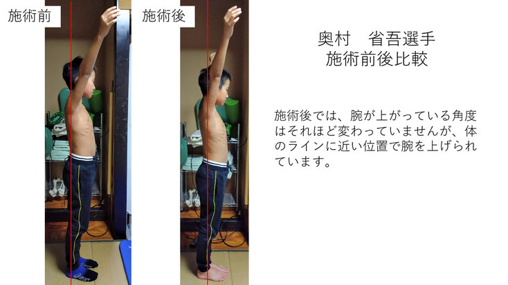 肩関節の痛み　姿勢　肩甲骨　肩甲骨痛み　背中の痛み　野球肩の原因　野球肩原因　野球肩治し方　野球肩体操　野球肩ストレッチ　野球　野球肩　肩が痛い　ピッチャー　リトルリーガーズショルダー　腱板損傷　投球傷害　水泳　競泳　腰痛　分離症　分離すべり症　水泳肩スイマーズショルダー　水泳肩　スイマーズショルダー治療　スイマーズショルダー治るのか　岐阜　岐阜市　岐阜市茜部　岐阜市東鶉　岐阜市南鶉　岐阜市中鶉　岐阜市柳津町　羽島市　羽島郡　笠松町　岐南町　茜部　鶉　東鶉　中鶉　南鶉　柳津　笠松　