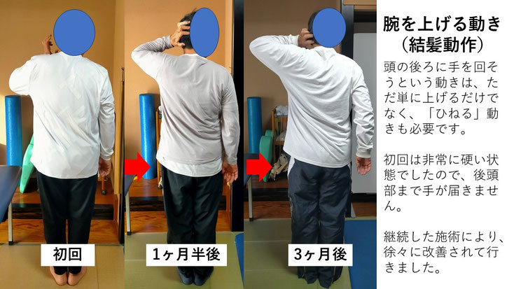 五十肩の施術例。初回から3か月後にかけて肩の可動域が改善し、腕を頭の後ろまで上げられるようになった症例。