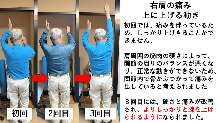 五十肩の施術例。初回から3回目に肩の可動域が改善し、腕を痛み無く上げられるようになった症例