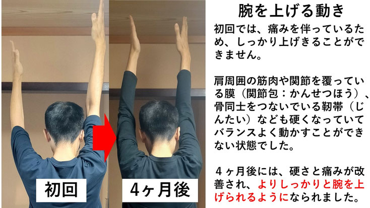 五十肩の施術例。初回から4か月後にかけて肩の可動域が改善し、腕を後ろに回せるようになった症例