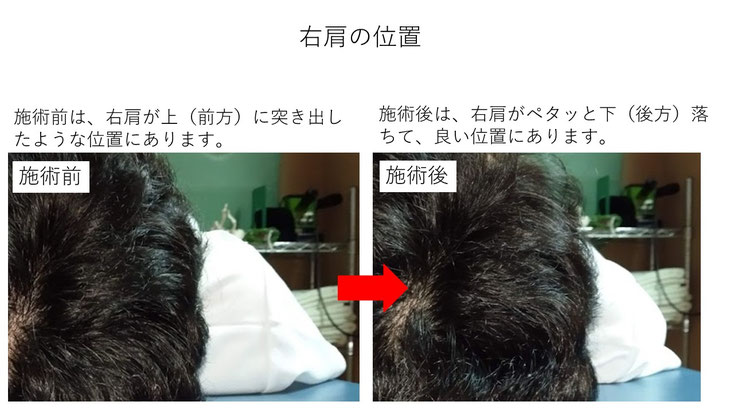 肩関節の痛み　姿勢　姿勢改善　肩甲骨　肩甲骨はがし　肩甲骨痛み　背中の痛み　野球肩の原因　野球肩原因　野球肩治し方　野球肩体操　野球肩ストレッチ　野球　野球肩　肩が痛い　ピッチャー　リトルリーガーズショルダー　腱板損傷　投球傷害　水泳　競泳　腰痛　分離症　分離すべり症　水泳肩スイマーズショルダー　水泳肩　スイマーズショルダー治療　スイマーズショルダー治るのか　岐阜　岐阜市　岐阜市茜部　岐阜市東鶉　岐阜市南鶉　岐阜市中鶉　岐阜市柳津町　羽島市　羽島郡　笠松町　岐南町　茜部　鶉　東鶉　中鶉　南鶉　柳津　笠松　