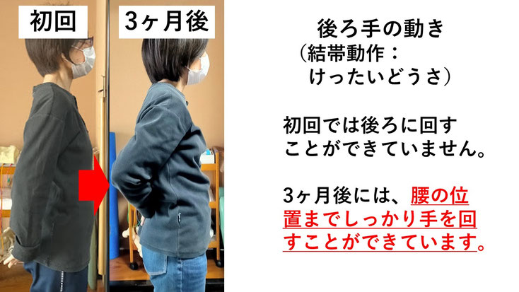 五十肩の施術例。初回から3か月後にかけて肩の可動域が改善し、腕を痛み無く後ろに回せるようになった症例