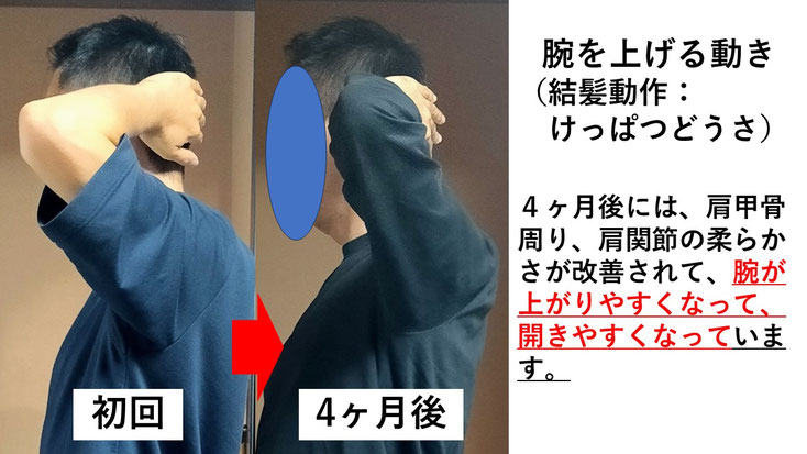 五十肩の施術例。初回から4か月後にかけて肩の可動域が改善し、腕を頭の後ろに回せるようになった症例