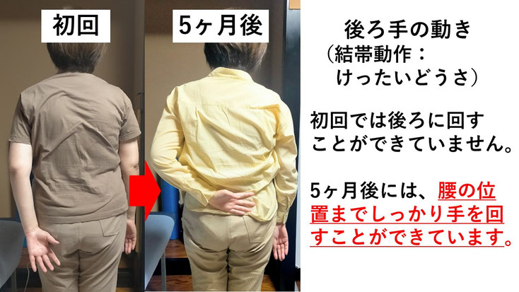 五十肩の施術例。初回から5か月後にかけて肩の可動域が改善し、手を後ろに回せるようになった症例