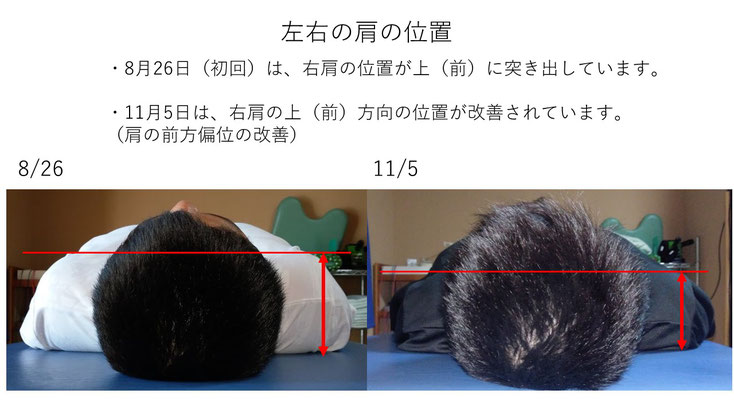 肩関節の痛み　姿勢　姿勢改善　肩甲骨　肩甲骨はがし　肩甲骨痛み　背中の痛み　野球肩の原因　野球肩原因　野球肩治し方　野球肩体操　野球肩ストレッチ　野球　野球肩　肩が痛い　ピッチャー　リトルリーガーズショルダー　腱板損傷　投球傷害　水泳　競泳　腰痛　分離症　分離すべり症　水泳肩スイマーズショルダー　水泳肩　スイマーズショルダー治療　スイマーズショルダー治るのか　岐阜　岐阜市　岐阜市茜部　岐阜市東鶉　岐阜市南鶉　岐阜市中鶉　岐阜市柳津町　羽島市　羽島郡　笠松町　岐南町　茜部　鶉　東鶉　中鶉　南鶉　柳津　笠松　