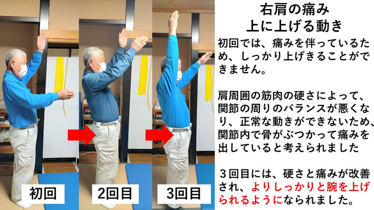 五十肩の施術例。初回から3回目に肩の可動域が改善し、腕を痛み無く上げられるようになった症例