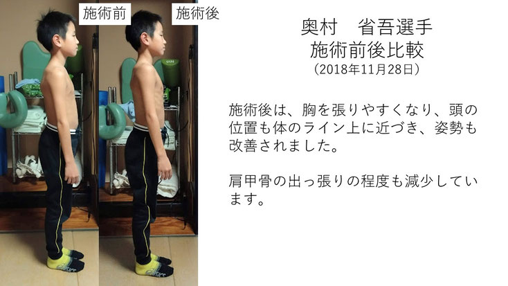肩関節の痛み　姿勢　肩甲骨　肩甲骨痛み　背中の痛み　野球肩の原因　野球肩原因　野球肩治し方　野球肩体操　野球肩ストレッチ　野球　野球肩　肩が痛い　ピッチャー　リトルリーガーズショルダー　腱板損傷　投球傷害　水泳　競泳　腰痛　分離症　分離すべり症　水泳肩スイマーズショルダー　水泳肩　スイマーズショルダー治療　スイマーズショルダー治るのか　岐阜　岐阜市　岐阜市茜部　岐阜市東鶉　岐阜市南鶉　岐阜市中鶉　岐阜市柳津町　羽島市　羽島郡　笠松町　岐南町　茜部　鶉　東鶉　中鶉　南鶉　柳津　笠松　