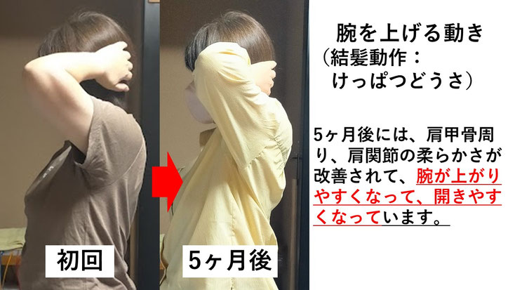 五十肩の施術例。初回から5か月後にかけて肩の可動域が改善し、手を頭の後ろまで回せるようになった症例