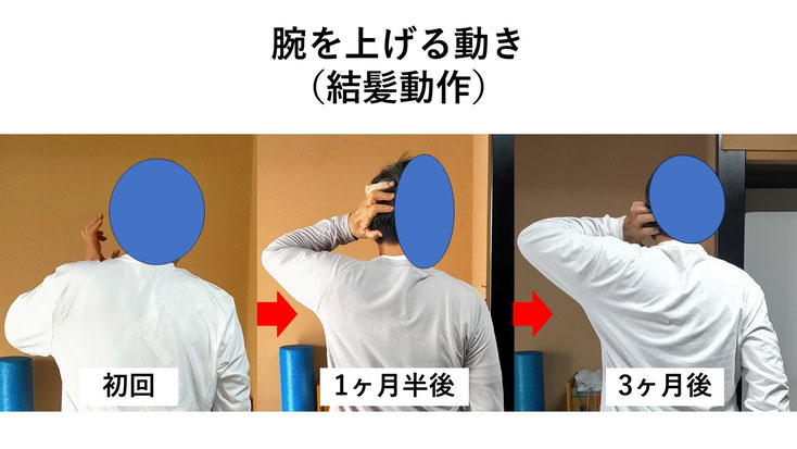 五十肩の施術例。初回から3か月後にかけて肩の可動域が改善し、腕を頭の後ろまで上げられるようになった症例。