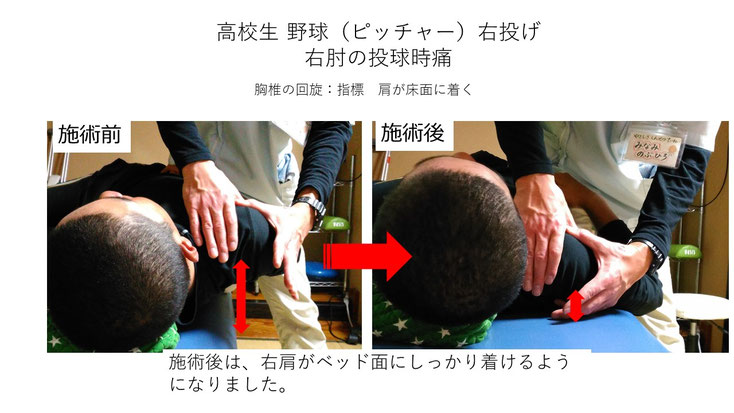 肩関節の痛み　姿勢　肩甲骨　肩甲骨痛み　背中の痛み　野球肩の原因　野球肩原因　野球肩治し方　野球肩体操　野球肩ストレッチ　野球　野球肩　肩が痛い　ピッチャー　リトルリーガーズショルダー　腱板損傷　投球傷害　水泳　競泳　腰痛　分離症　分離すべり症　水泳肩スイマーズショルダー　水泳肩　スイマーズショルダー治療　スイマーズショルダー治るのか　岐阜　岐阜市　岐阜市茜部　岐阜市東鶉　岐阜市南鶉　岐阜市中鶉　岐阜市柳津町　羽島市　羽島郡　笠松町　岐南町　茜部　鶉　東鶉　中鶉　南鶉　柳津　笠松　